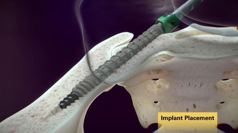 medical device animation, video